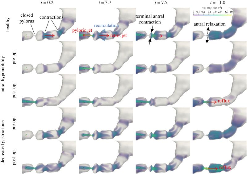 In Silico Modelling of Pyloric Intervention Procedures in Gastroparesis